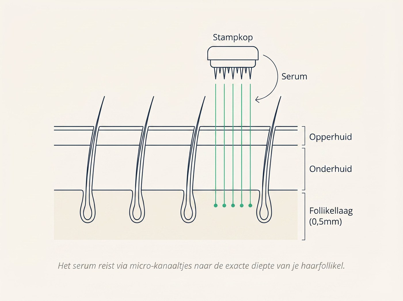 Diagram: dwarsdoorsnede van de hoofdhuid met opperhuid, onderhuid en follikellaag op 0,5mm diepte. Stampkop met micro-naaldjes laat serum (groene lijnen) direct bij de haarfollikels aankomen